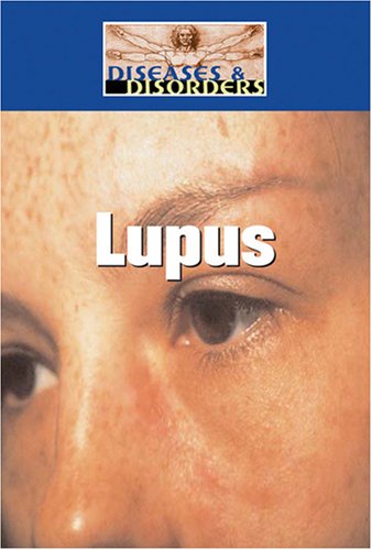 Lupus