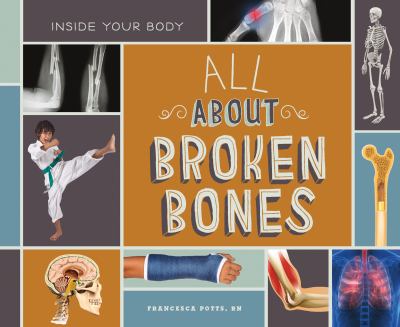 All about broken bones