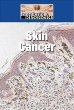 Skin cancer